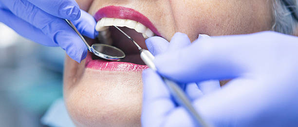 Best Knocked-Out Tooth (Avulsed Tooth) Treatment in Palm Springs North, FL